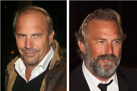 μεταμόσχευση μαλλιών και celebrities