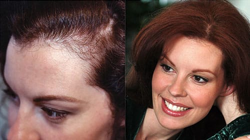 Τριχόπτωση μετά την εγκυμοσύνη Anastasakis Hair Clinic