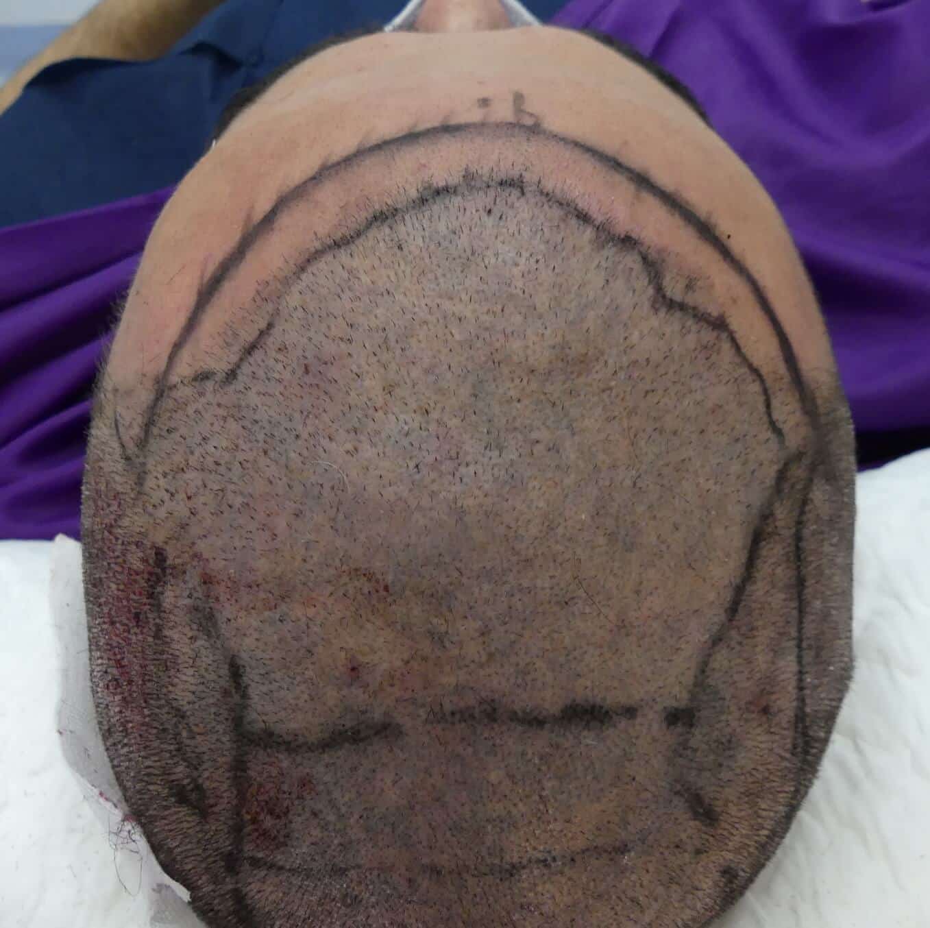 επανασχεδιασμός του hairline, η πανοραμική εικόνα - Anastasakis - 4