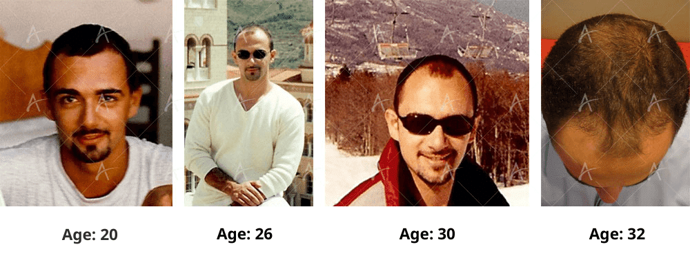 the progression of hair loss over the years