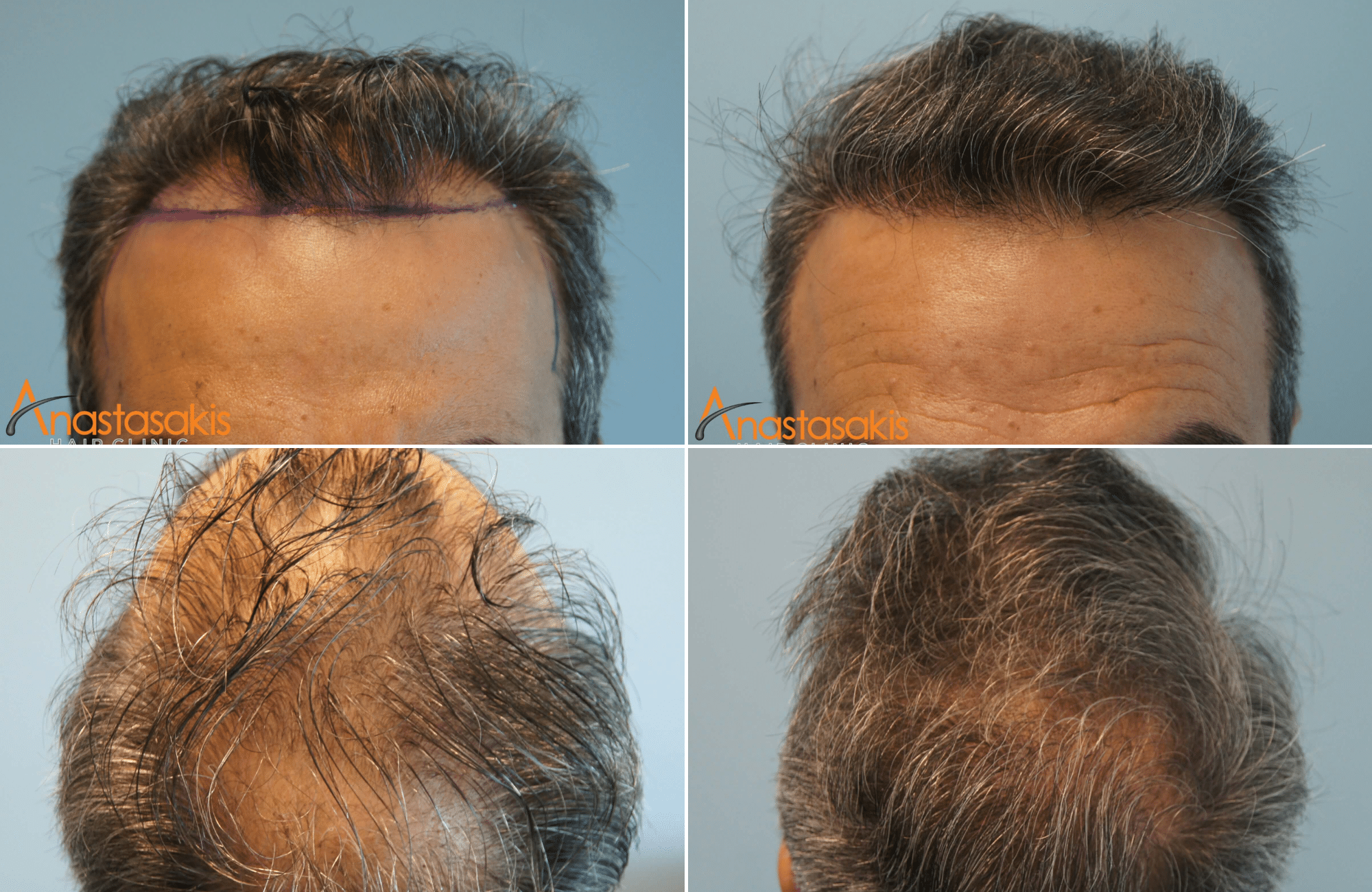 https://anastasakishairclinic.com/portfolio/%ce%b1%cf%80%ce%bf%cf%84%ce%ad%ce%bb%ce%b5%cf%83%ce%bc%ce%b1-%ce%bc%ce%b5-3020-fus/