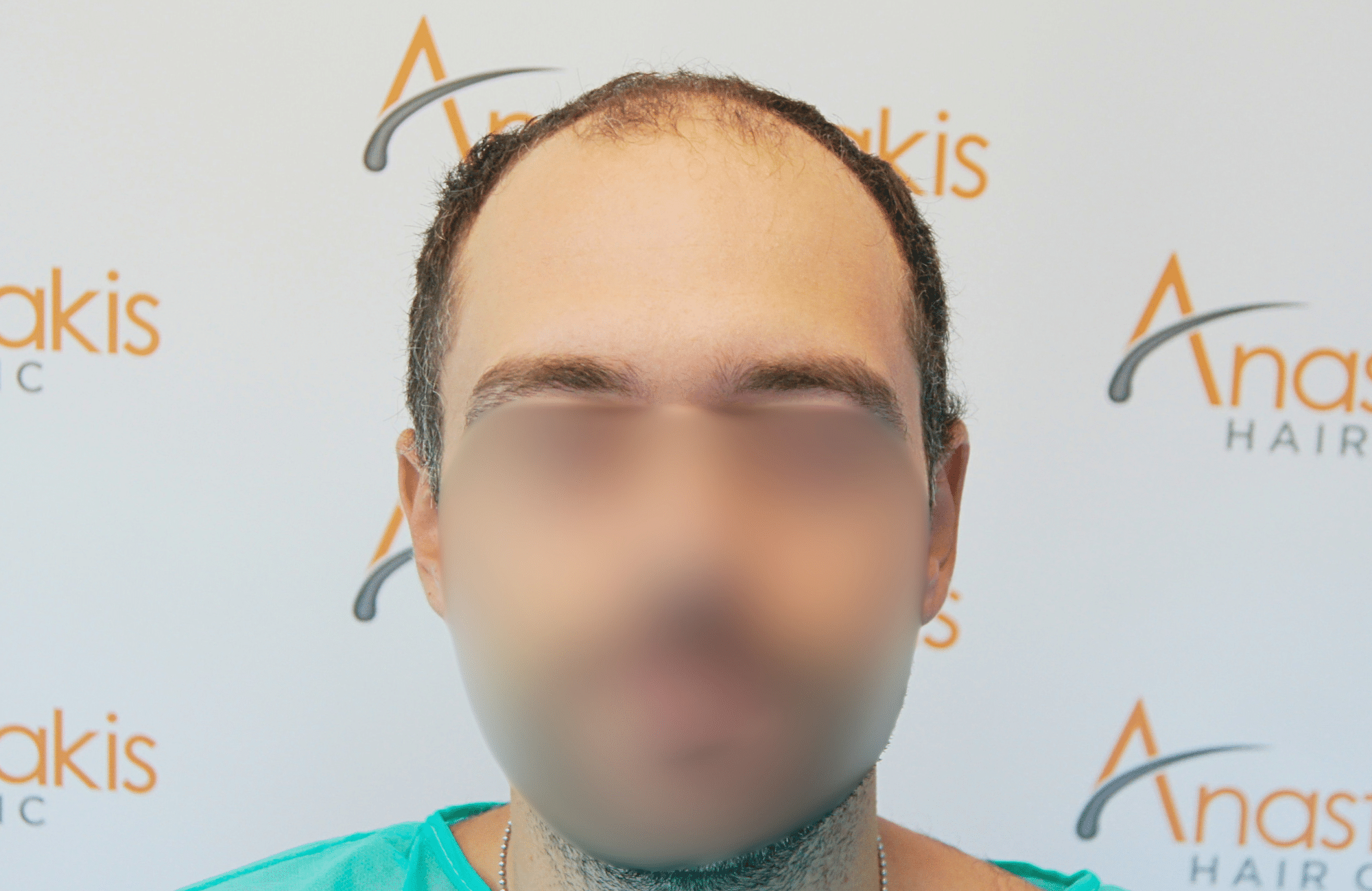 hair transplant result 2000 fus