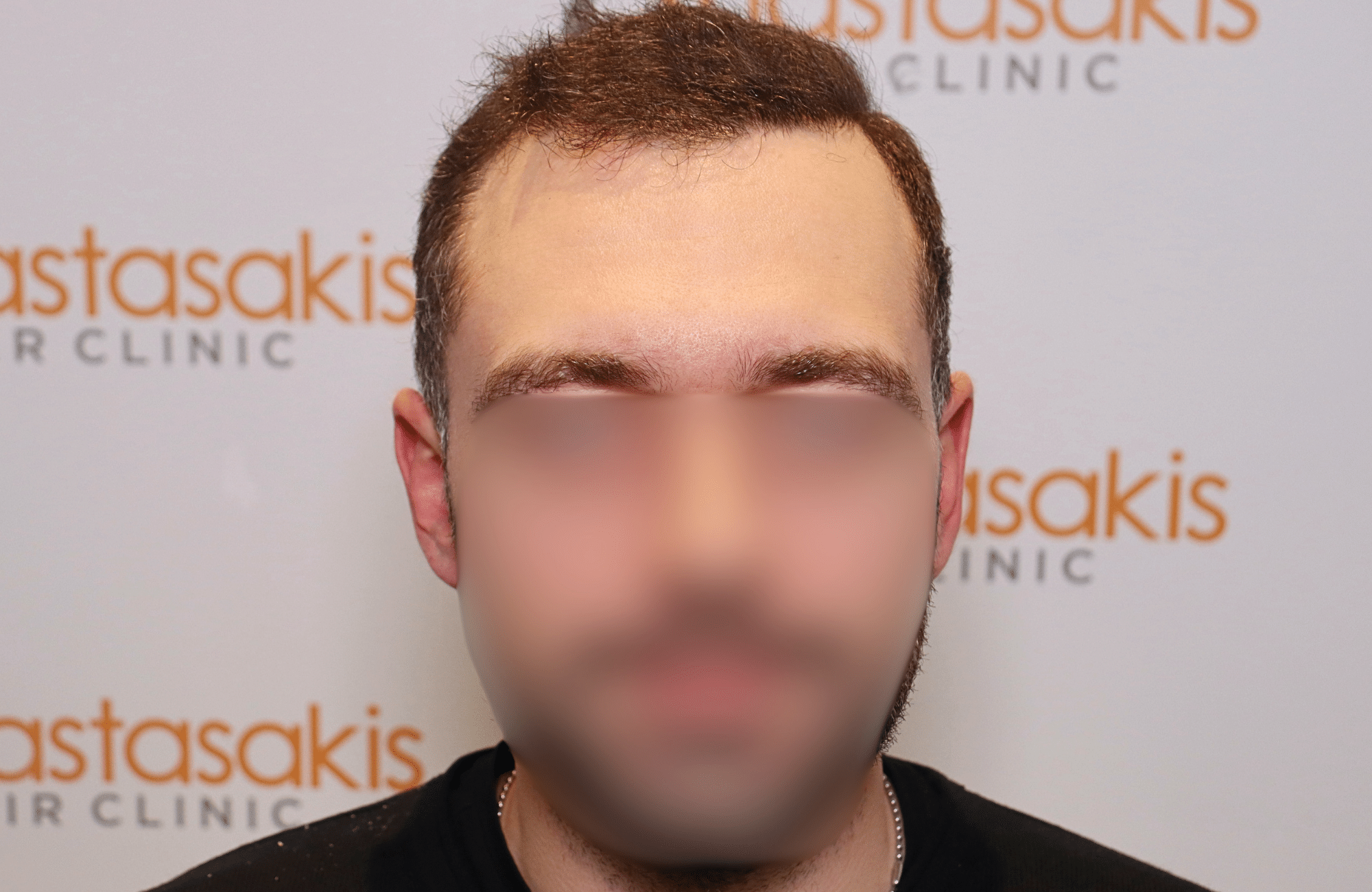 hair transplant result 2000 fus