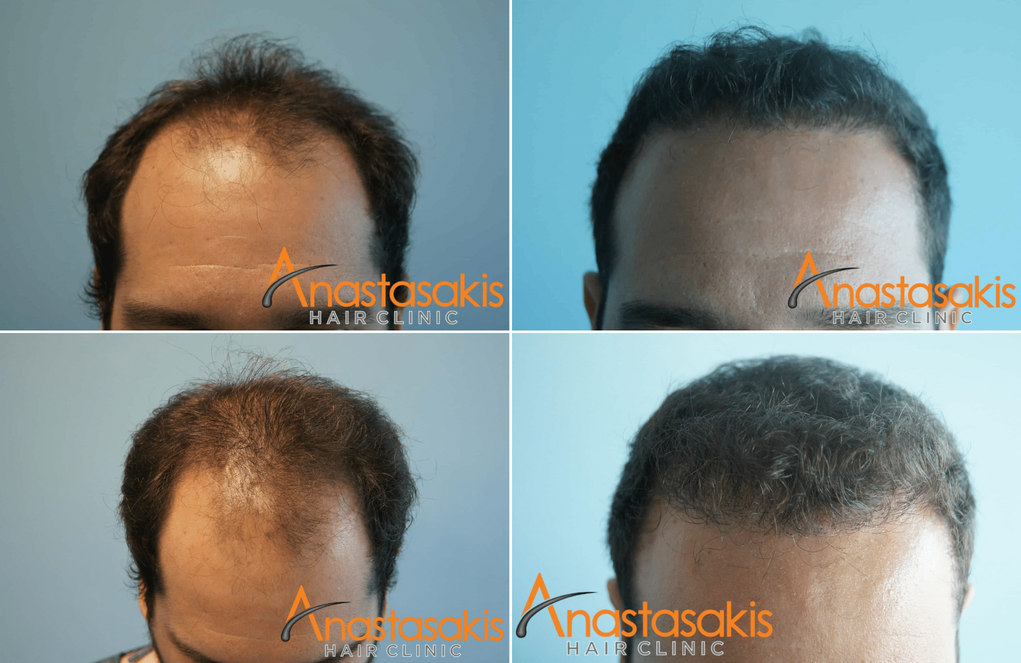 https://anastasakishairclinic.com/portfolio/result-anastasakishairclinic-3000fus_fut/