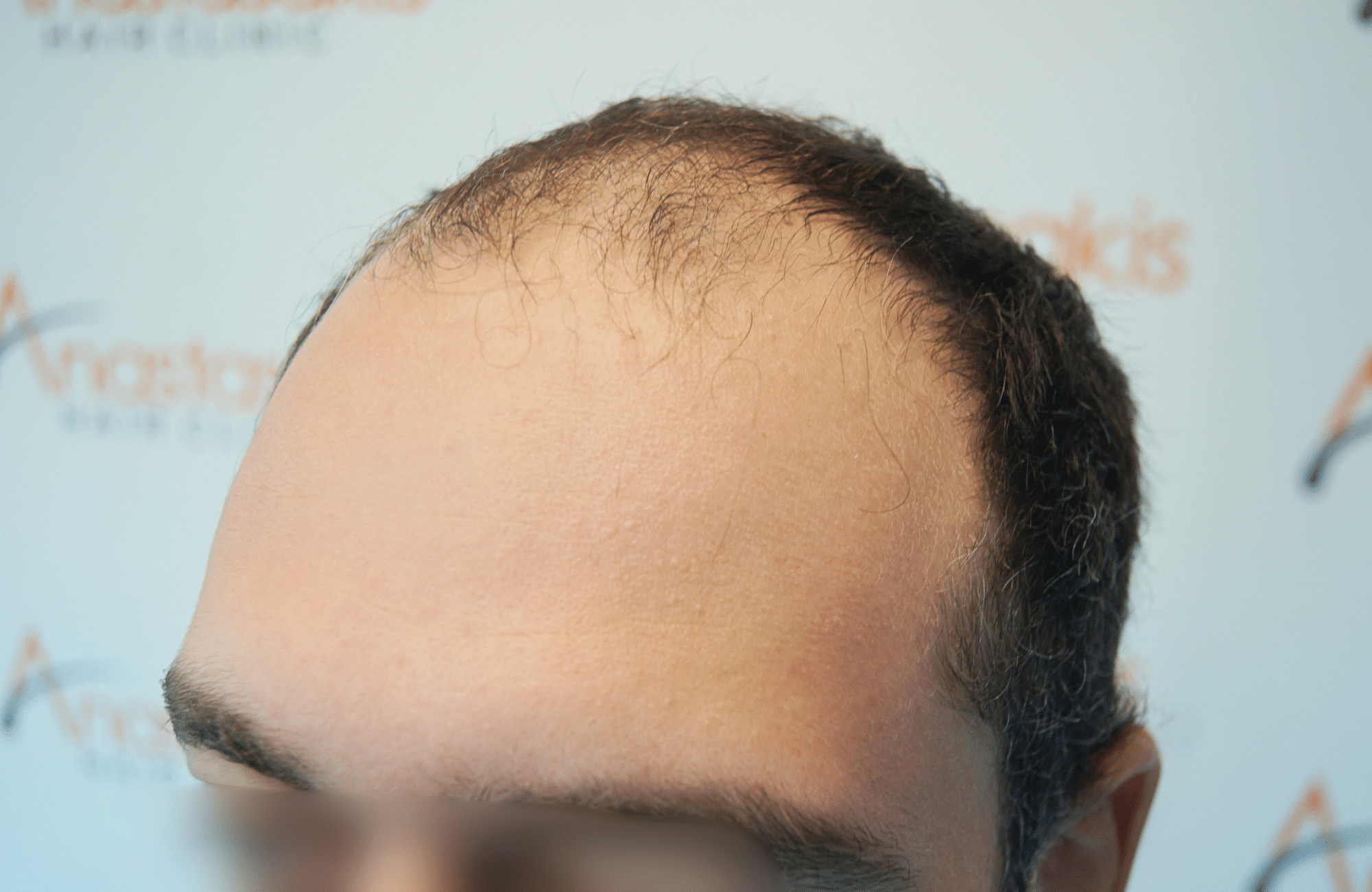 hair transplant result 2000 fus