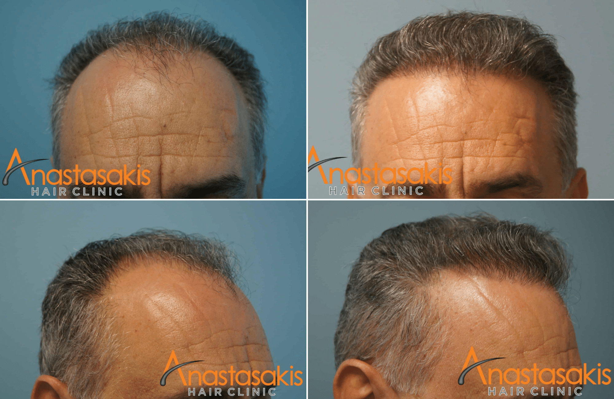 https://anastasakishairclinic.com/portfolio/3000fus-9-anastasakishairclinic/