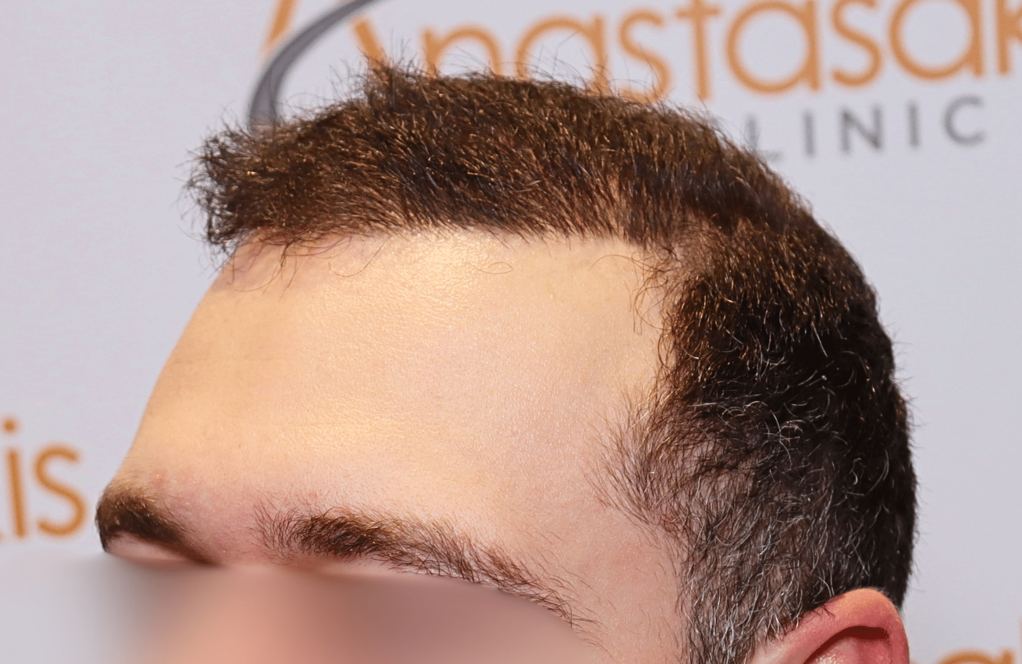 hair transplant result 2000 fus
