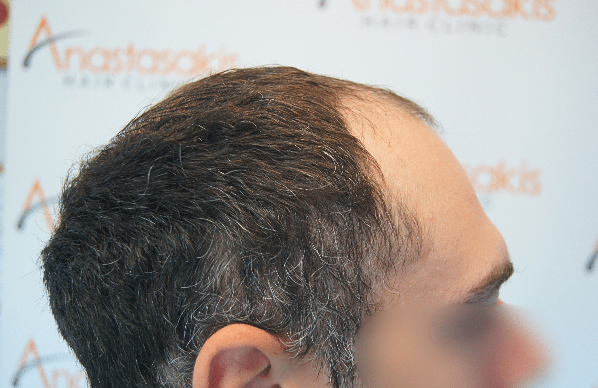 hair transplant result 2000 fus