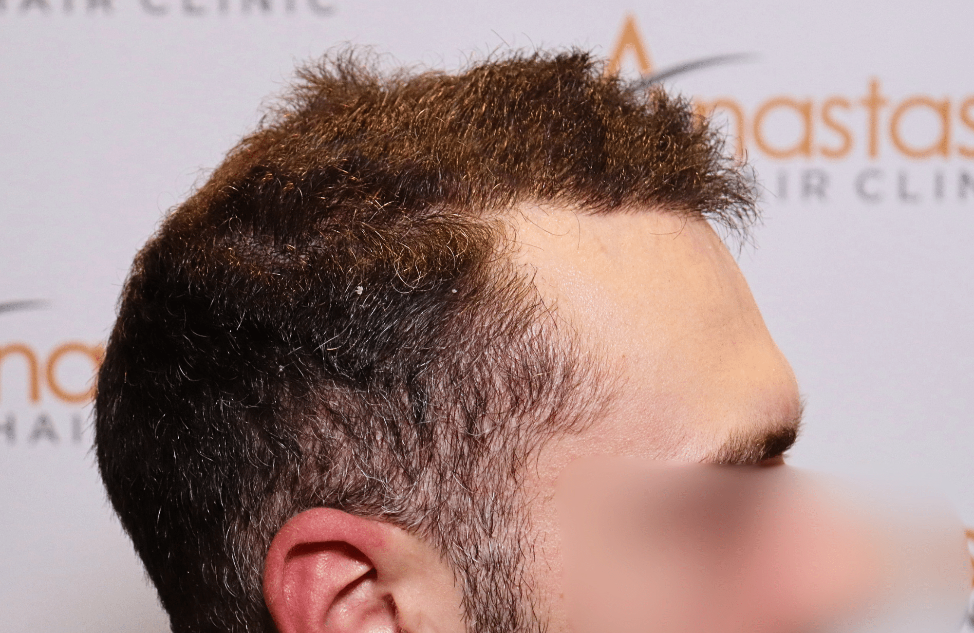 hair transplant result 2000 fus