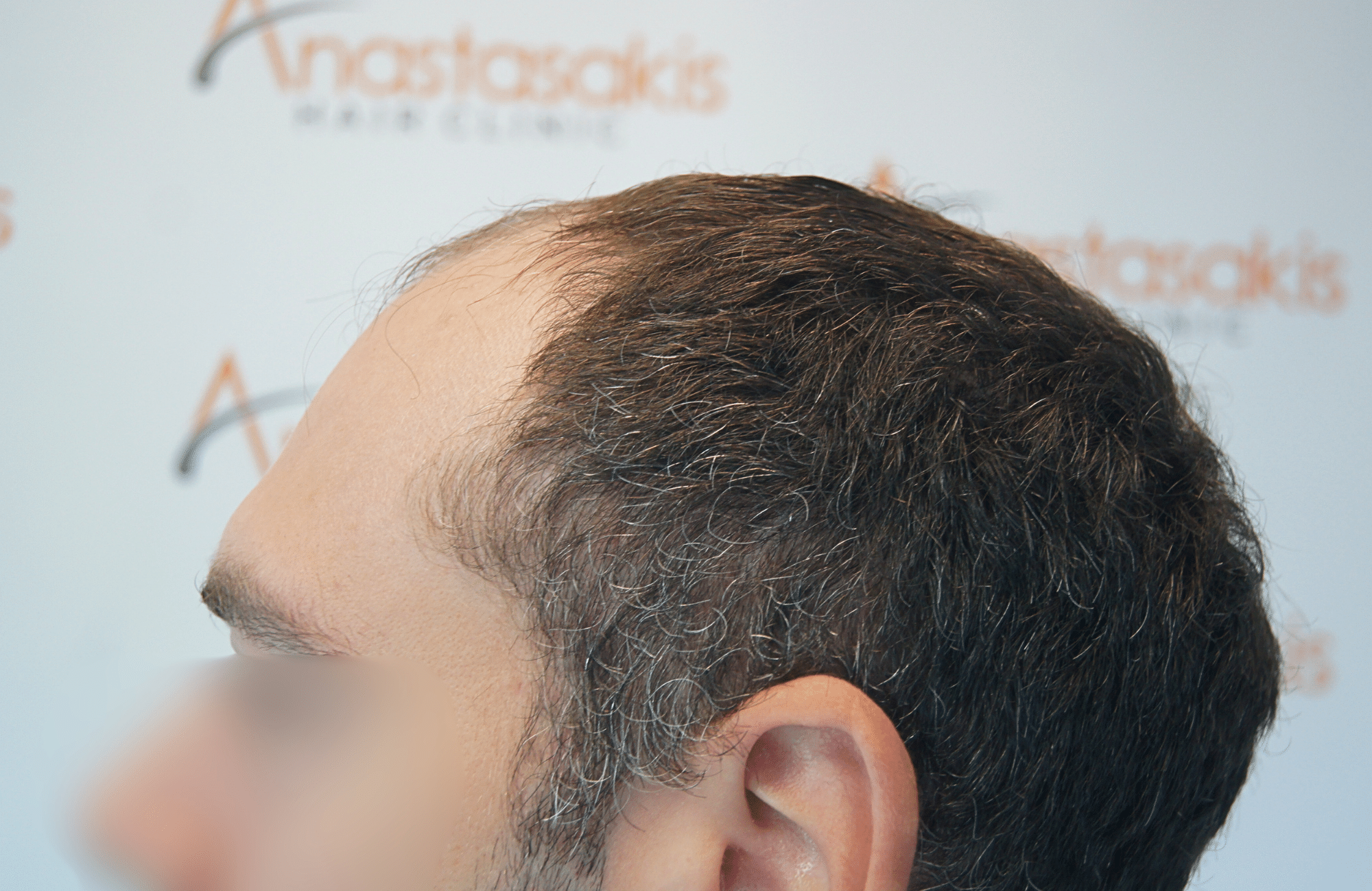 hair transplant result 2000 fus
