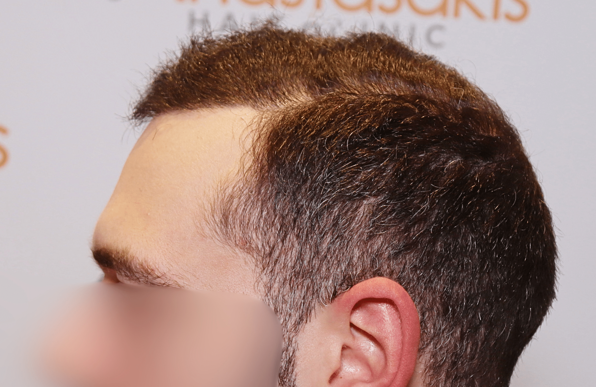 hair transplant result 2000 fus