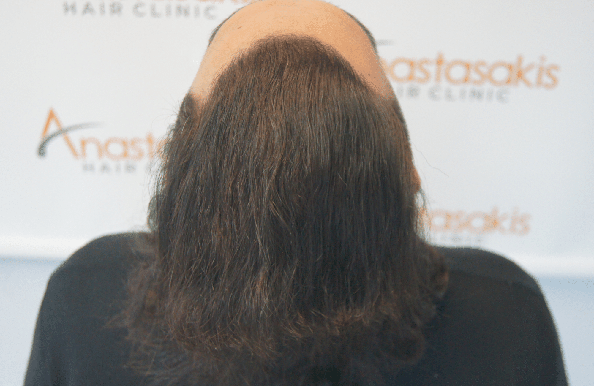 hair transplant result with 2500 follicular units anastasakis hair clinic