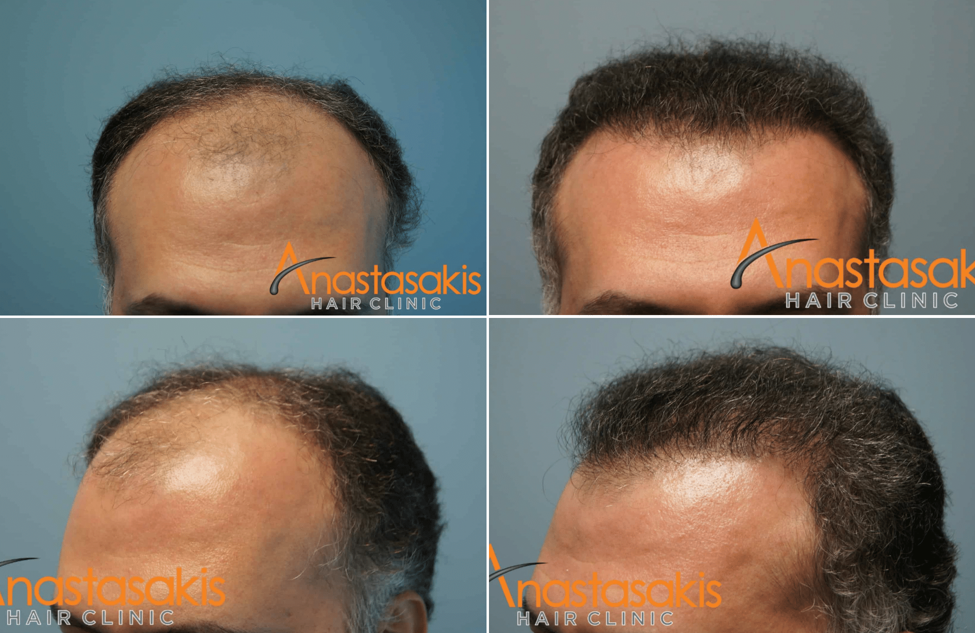 https://anastasakishairclinic.com/portfolio/2800fus-peristatikomm-anastasakis-hair-clinic/