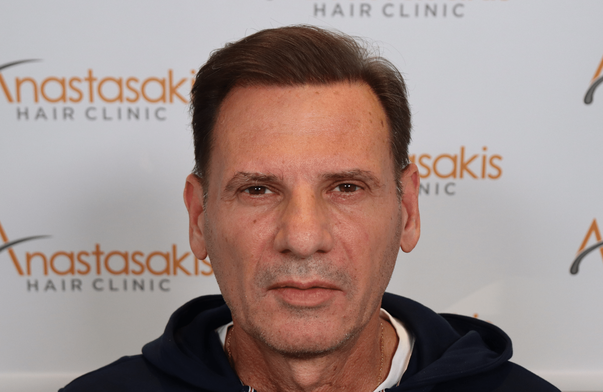 hair transplant result by anastassakis konstantinos after