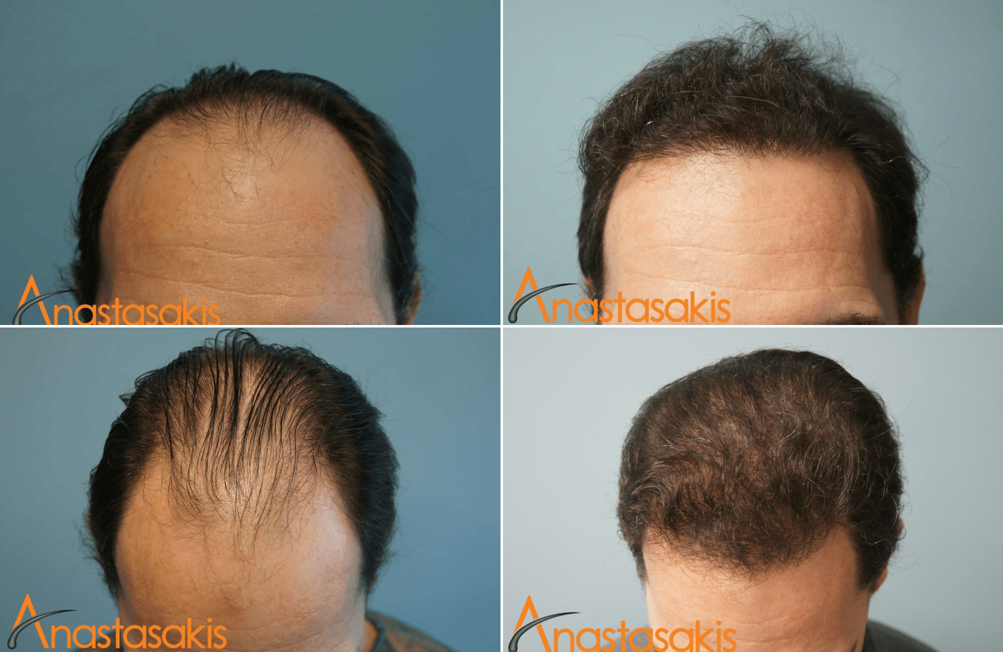 https://anastasakishairclinic.com/portfolio/2530-fus-fullhair-result-anastasakishairclinic/