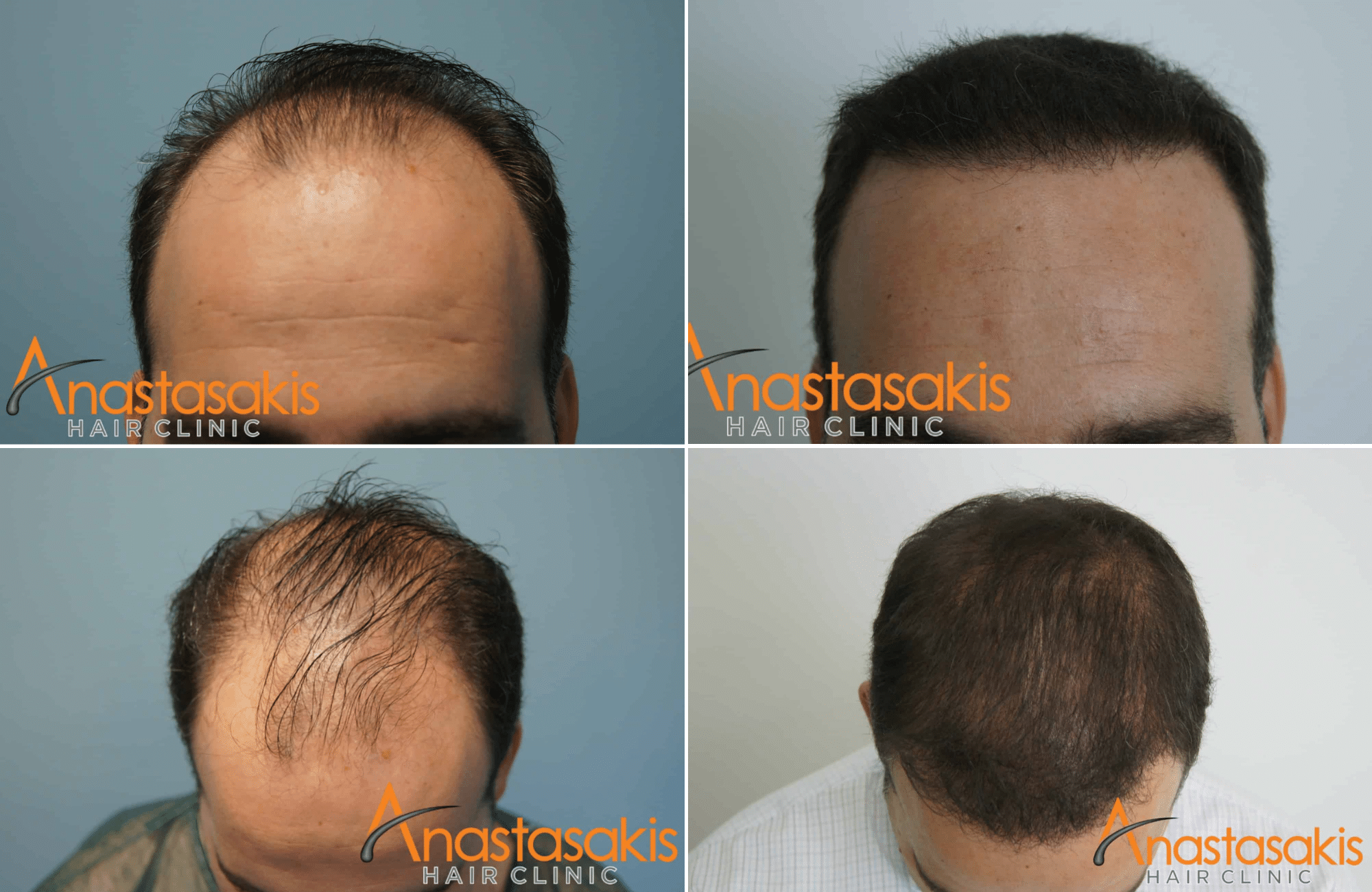 https://anastasakishairclinic.com/portfolio/anastasakishair-clinic-result-3000-fus-2/