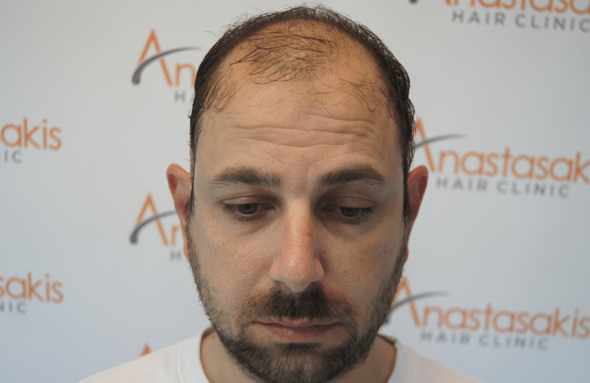 hair transplant result with 3500 follicular units anastasakis hair clinic