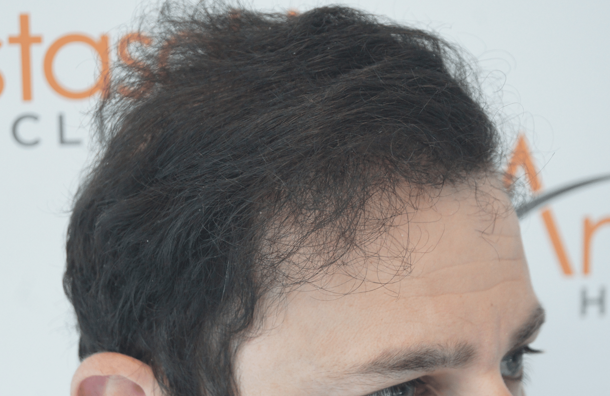 hair transplant result with 3500 follicular units anastasakis hair clinic