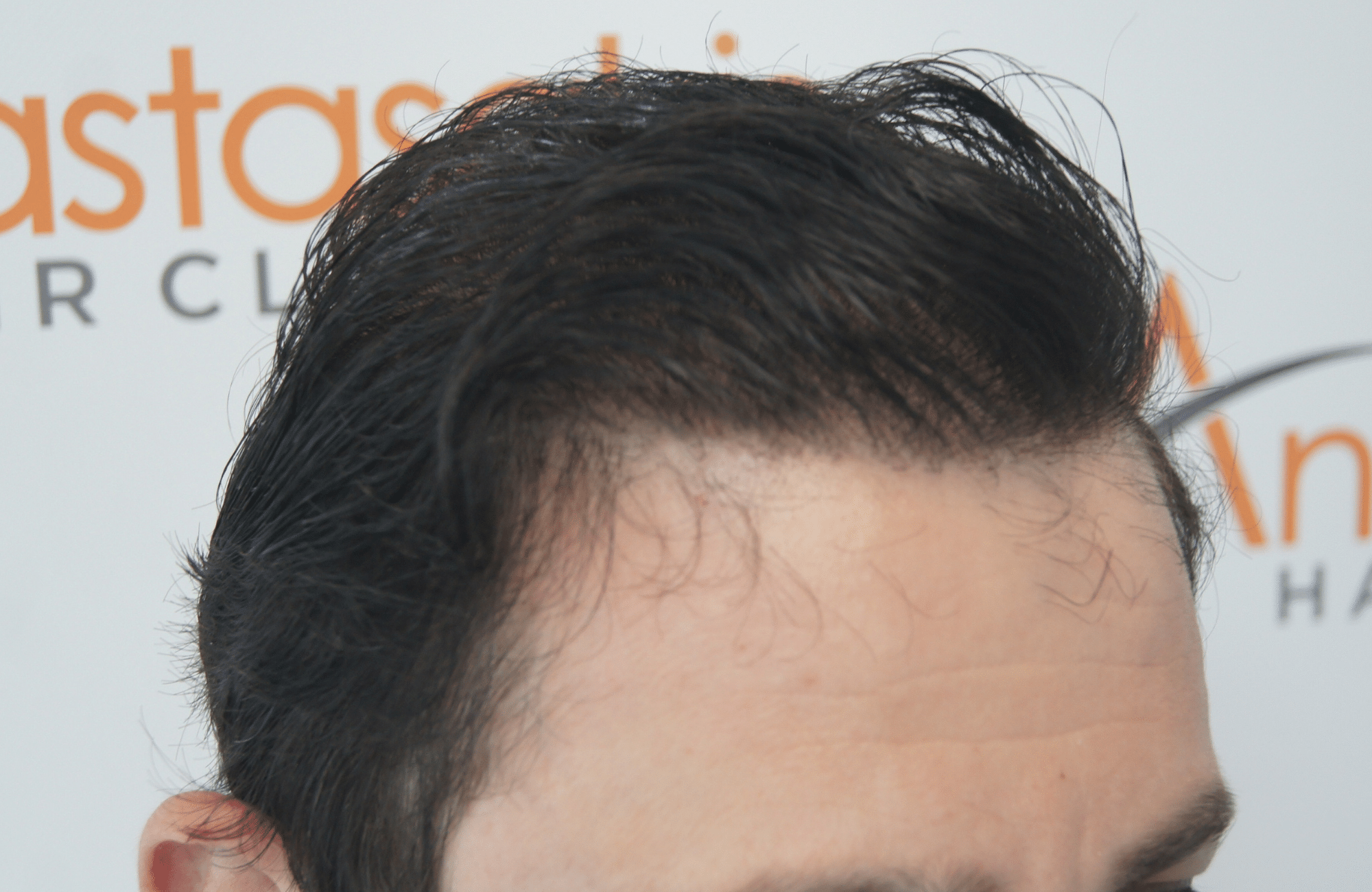 hair transplant result with 3500 follicular units anastasakis hair clinic
