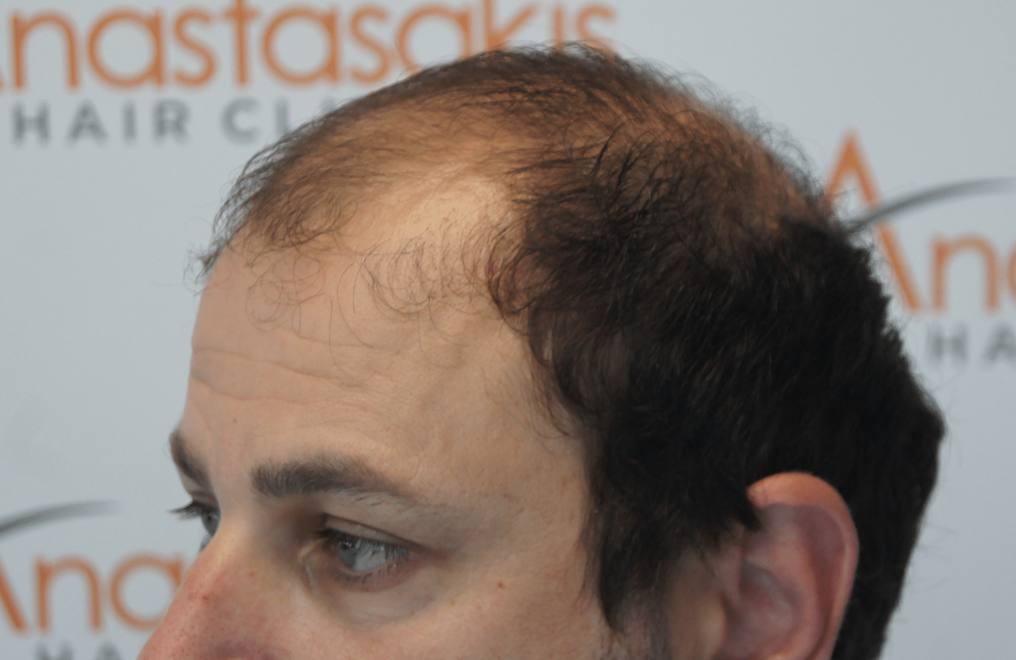 hair transplant result with 3500 follicular units anastasakis hair clinic