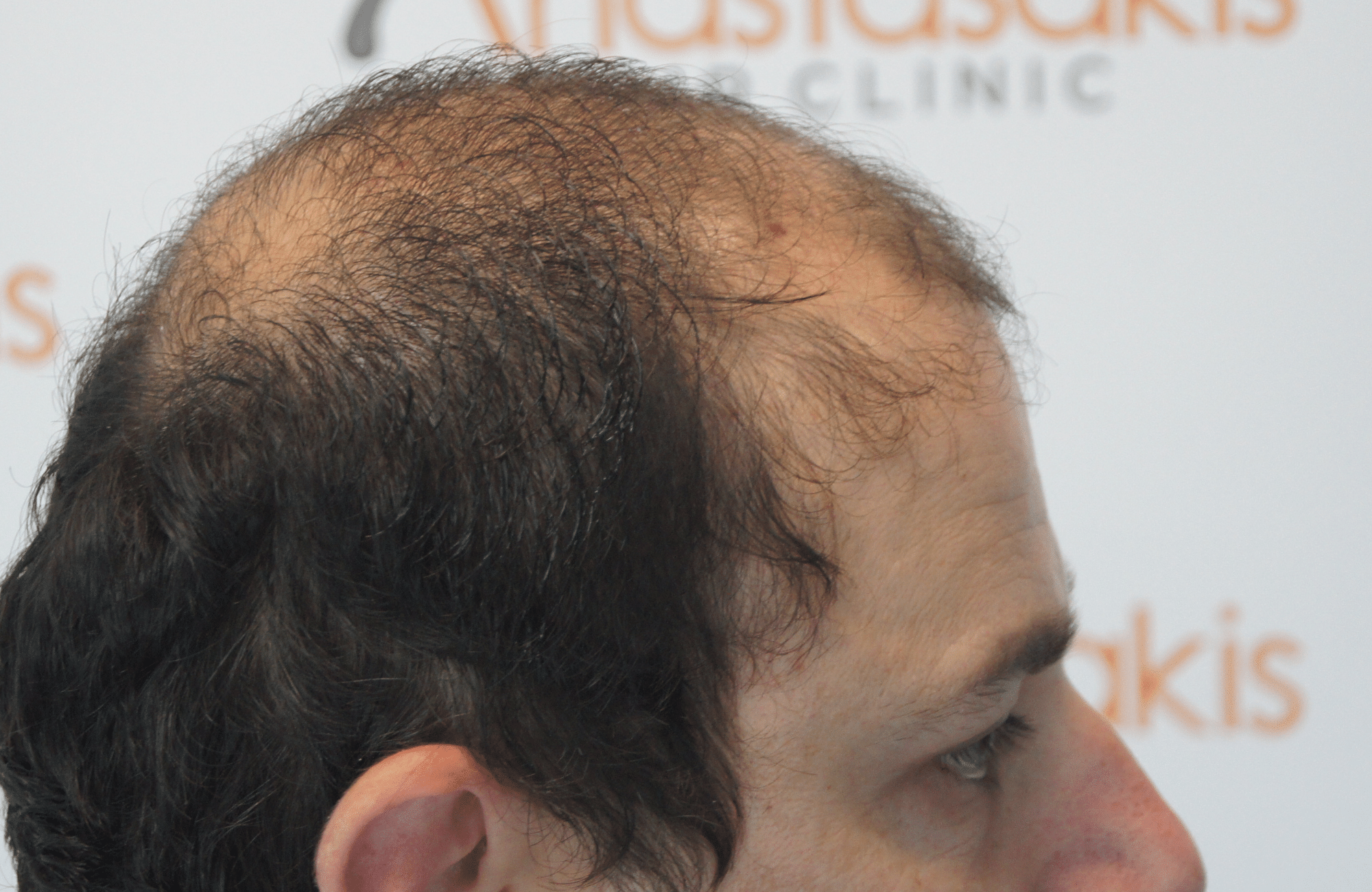 hair transplant result with 3500 follicular units anastasakis hair clinic