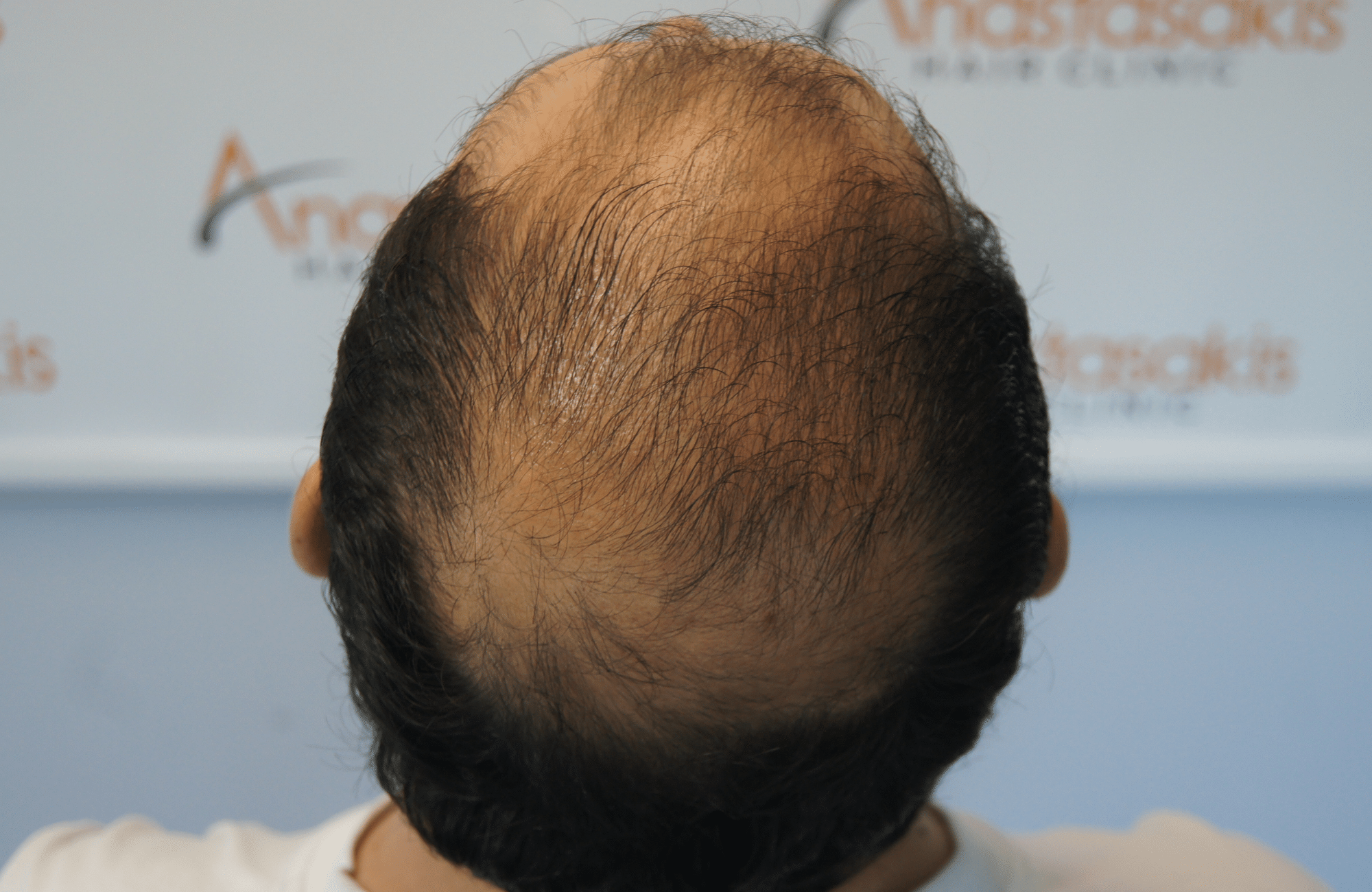 hair transplant result with 3500 follicular units anastasakis hair clinic