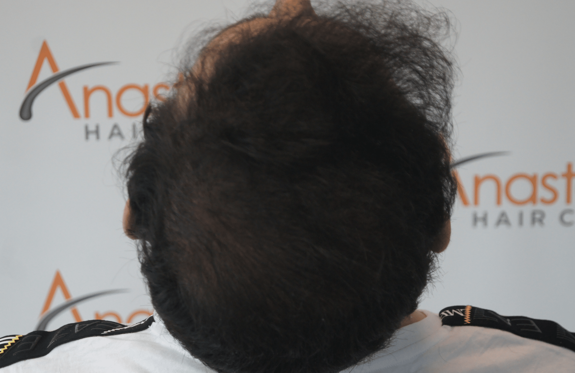 hair transplant result with 3500 follicular units anastasakis hair clinic