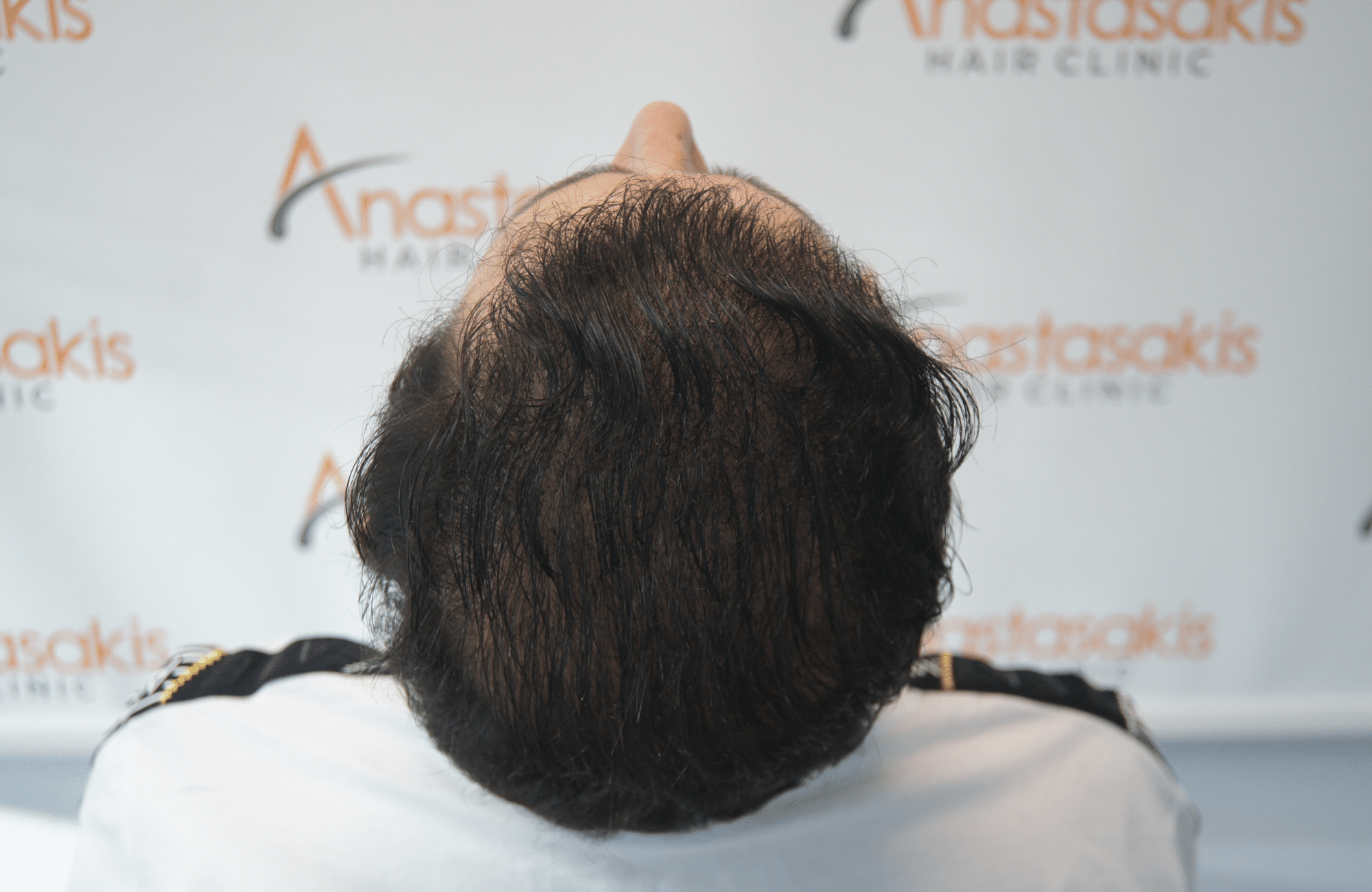 hair transplant result with 3500 follicular units anastasakis hair clinic
