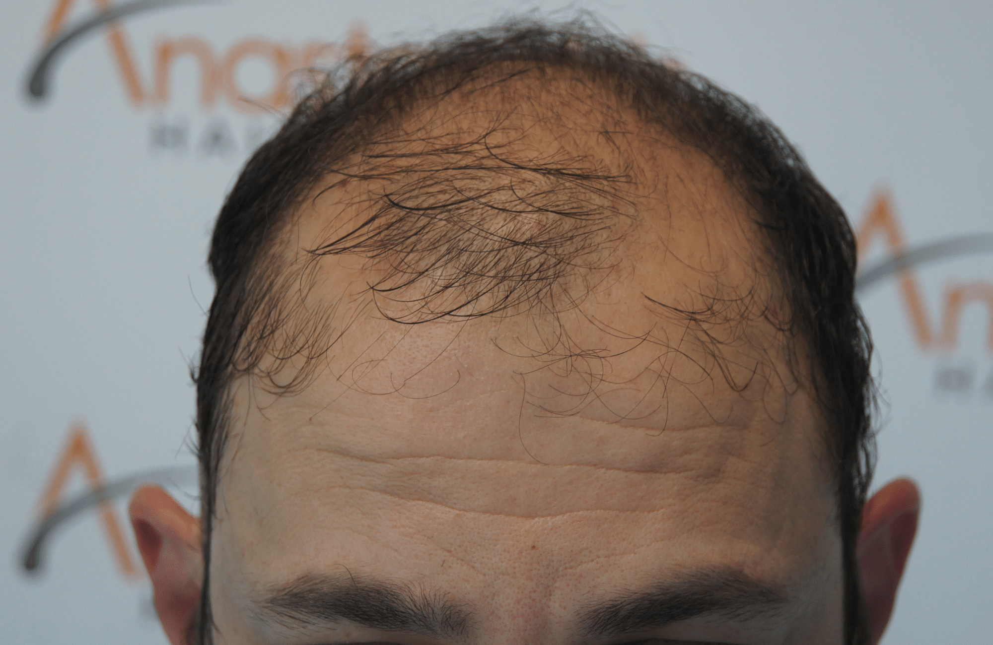 hair transplant result with 3500 follicular units anastasakis hair clinic