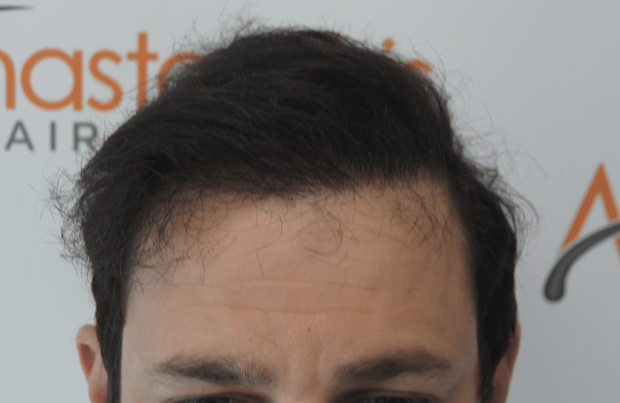 hair transplant result with 3500 follicular units anastasakis hair clinic