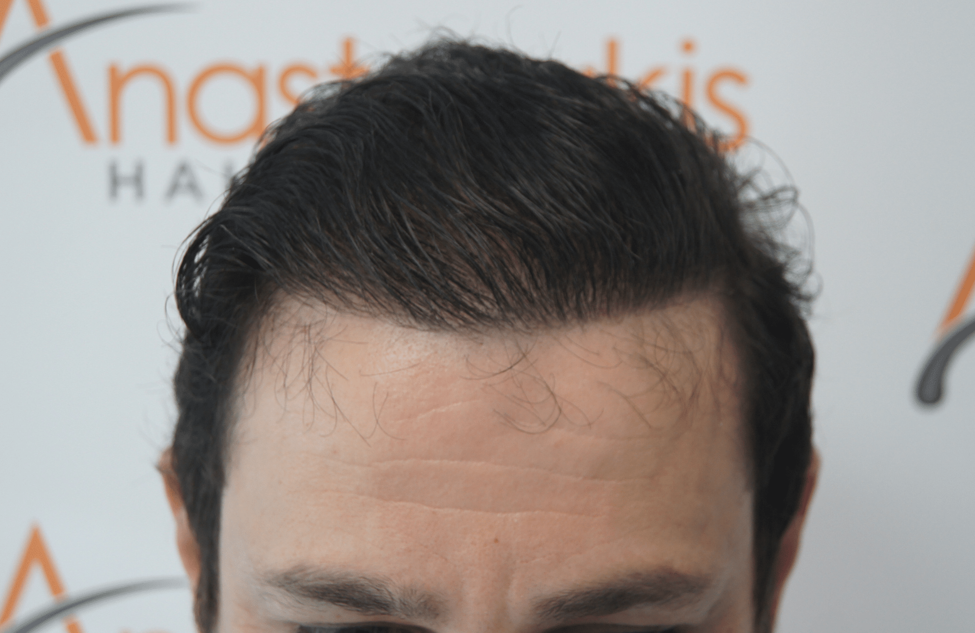 hair transplant result with 3500 follicular units anastasakis hair clinic