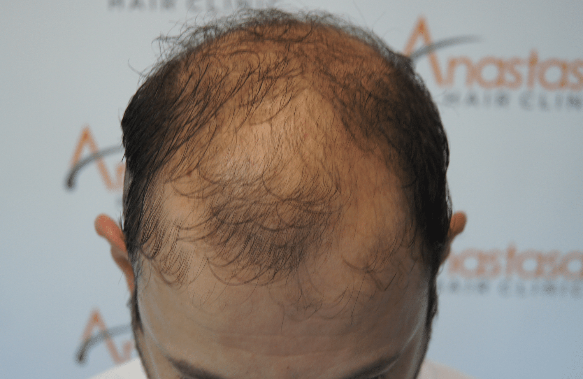 hair transplant result with 3500 follicular units anastasakis hair clinic
