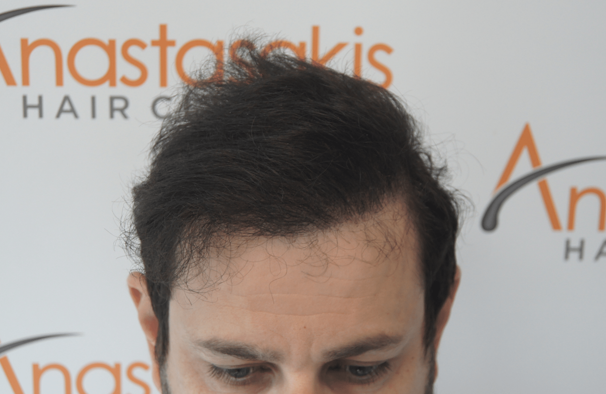 hair transplant result with 3500 follicular units anastasakis hair clinic