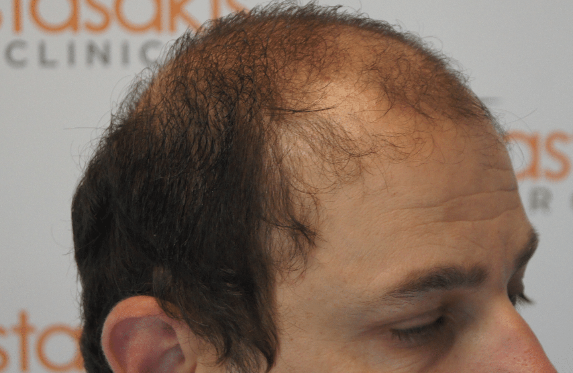hair transplant result with 3500 follicular units anastasakis hair clinic