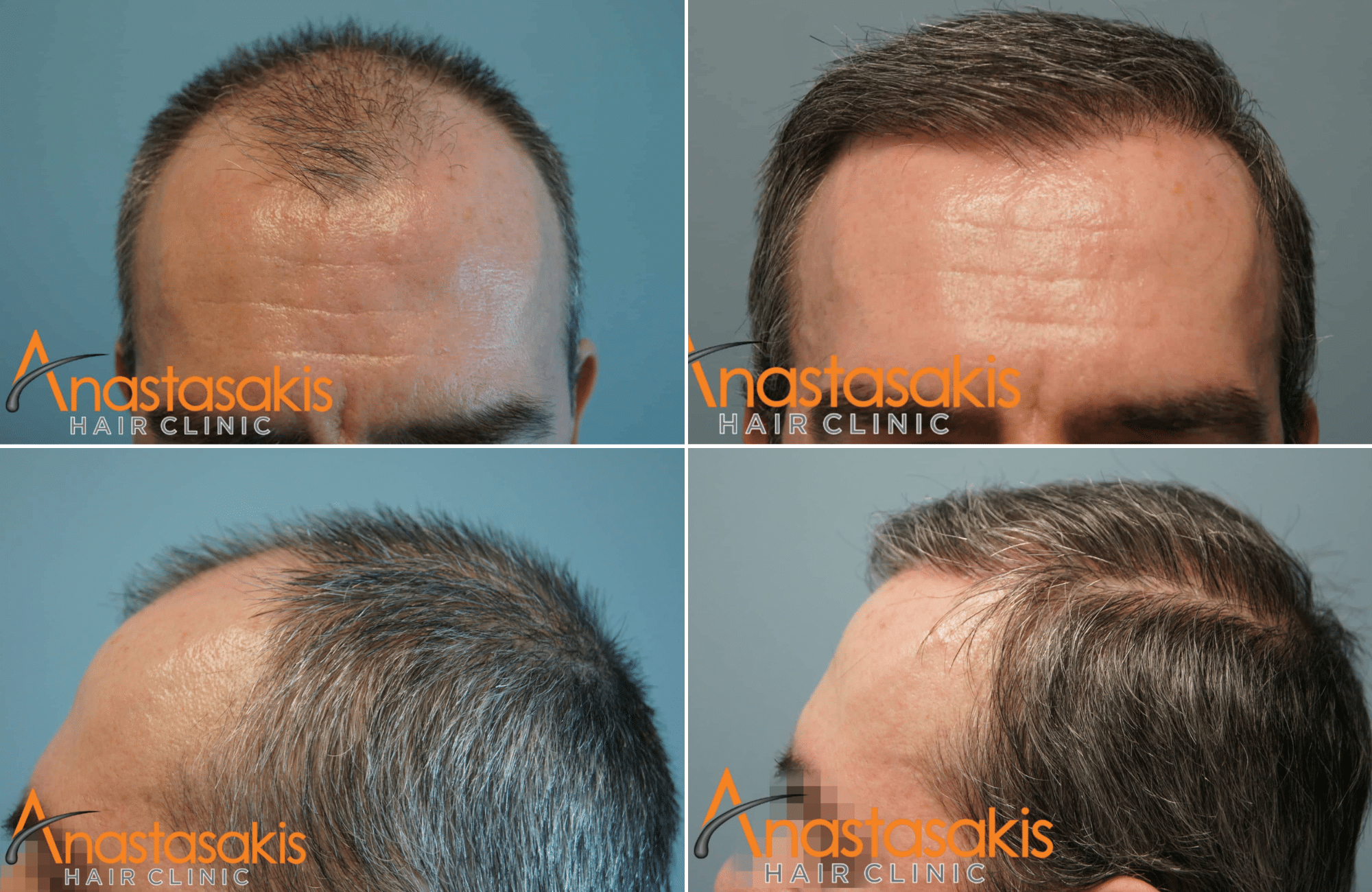 https://anastasakishairclinic.com/portfolio/metamosxefsi-mallion-ahc-3050-fus-2/
