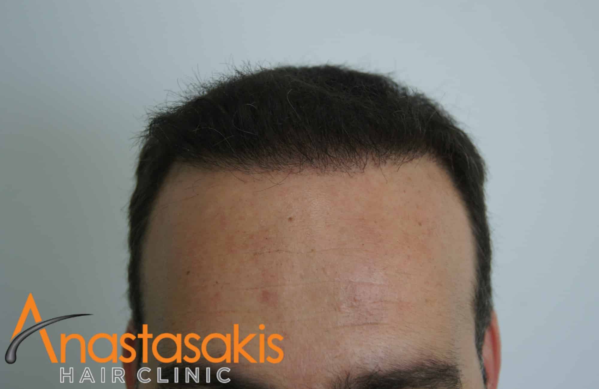 hairline ασθενους μετα τη μεταμοσχευση μαλλιων με 3000 fus