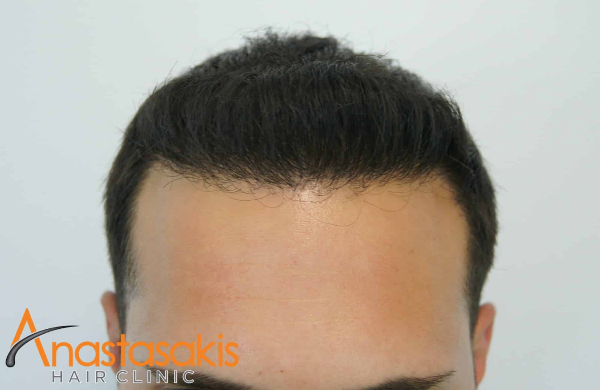 hairline άντρα μετά την επέμβαση fue με 1600 fus