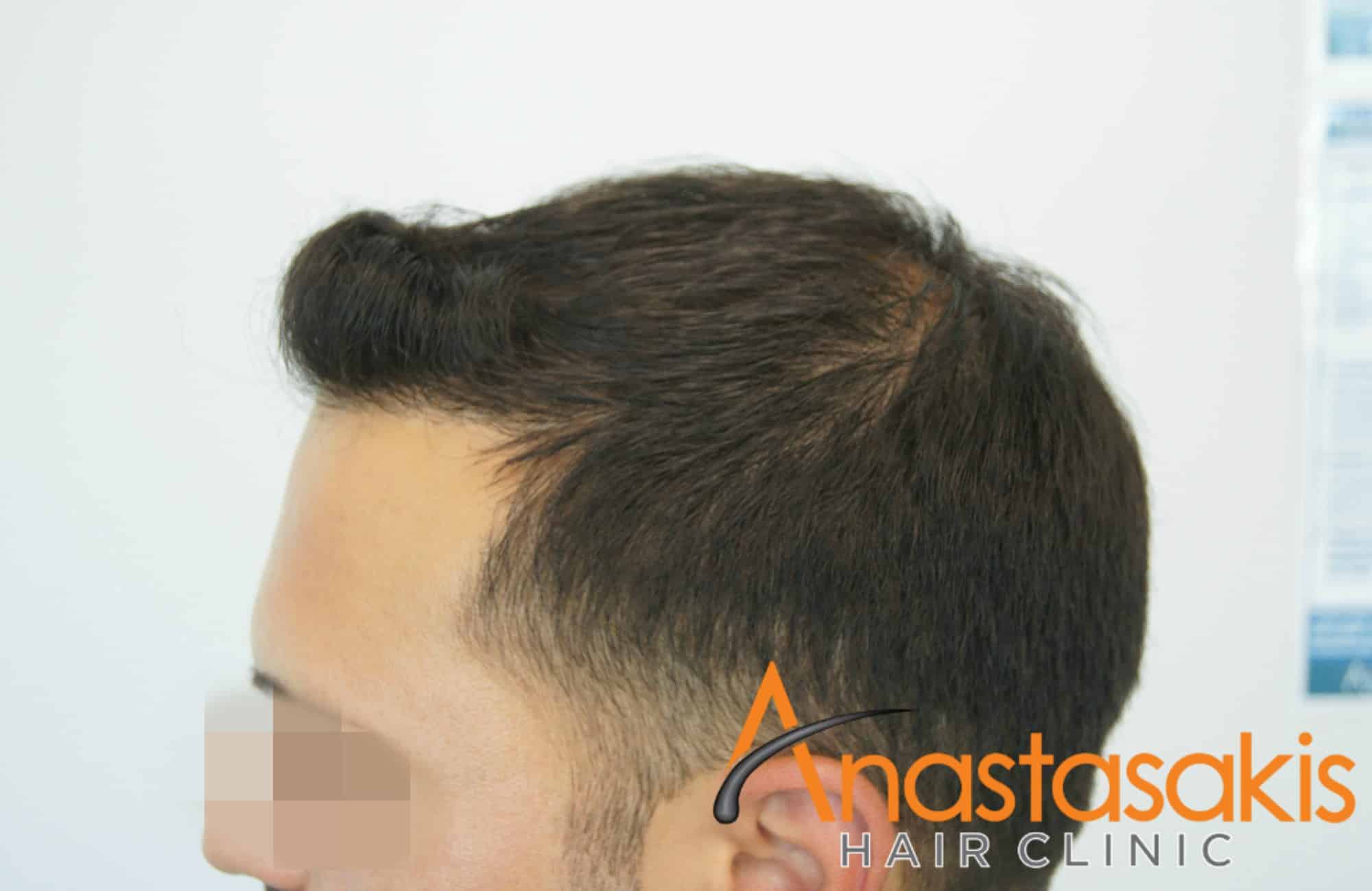 δεξί προφίλ άντρα μετά την επέμβαση fue με 1600 fus