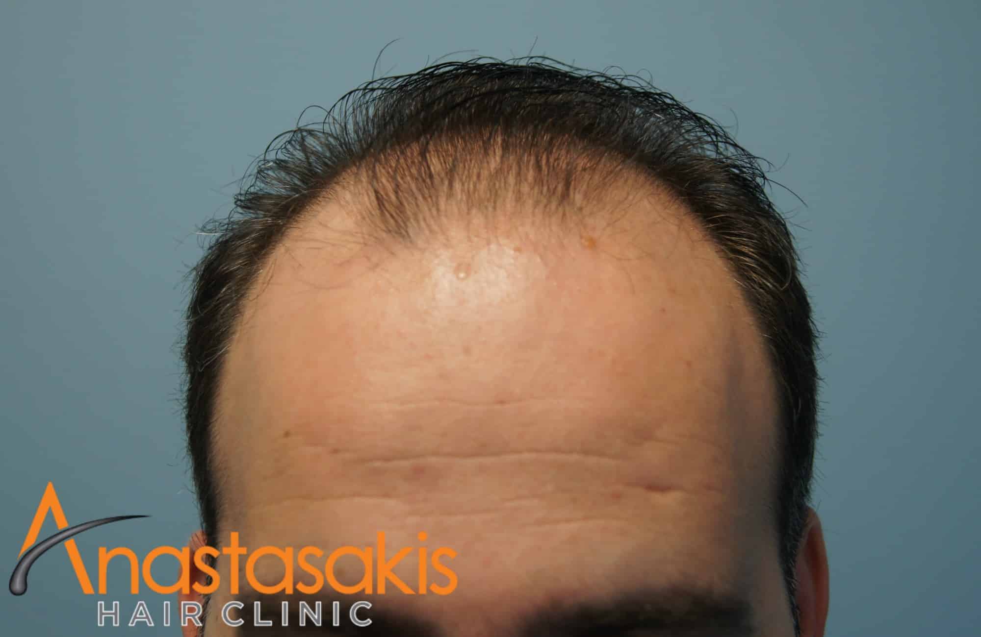 hairline ασθενους πριν τη μεταμοσχευση μαλλιων με 3000 fus