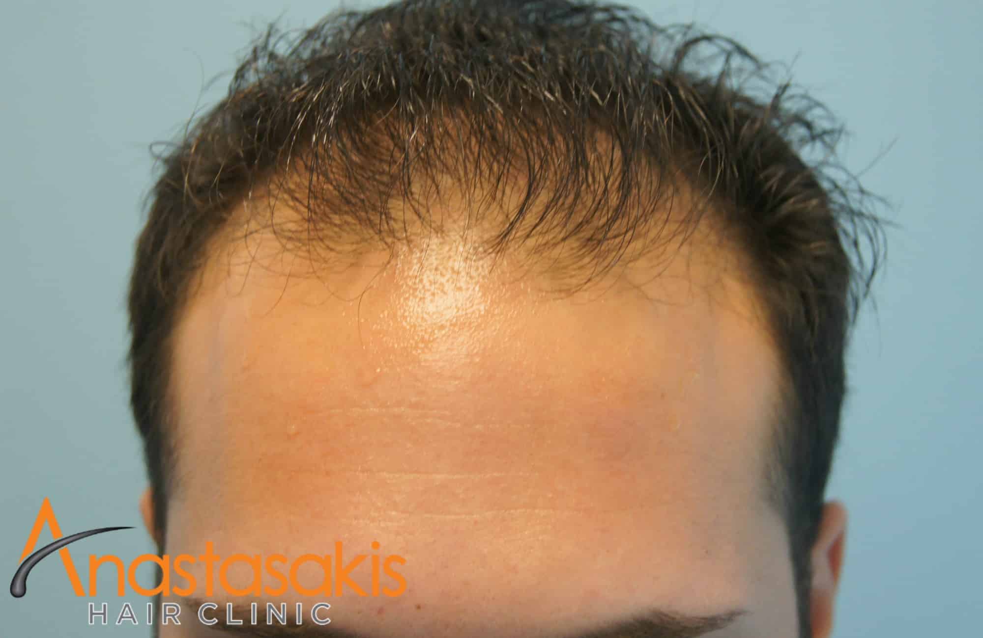 hairline άντρα πριν την επέμβαση fue με 1600 fus