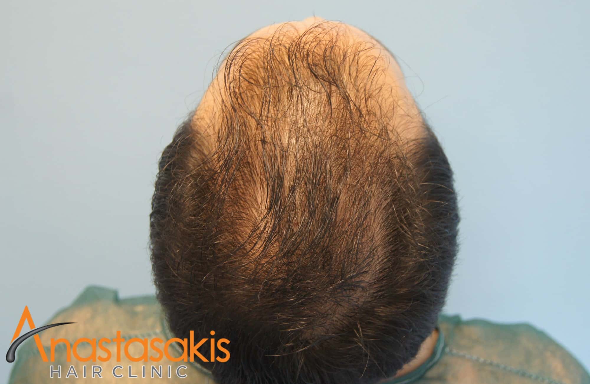 hairline άντρα πριν την επέμβαση fue με 1600 fus