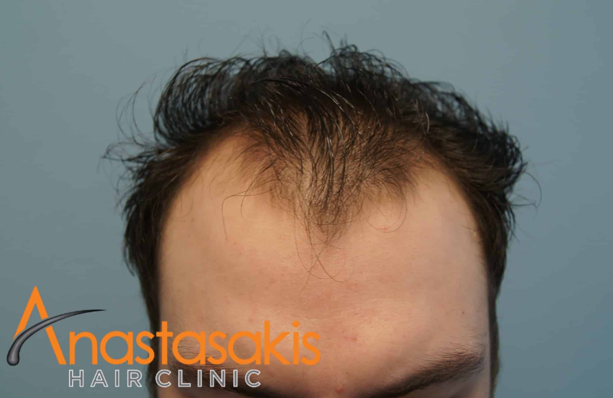 https://anastasakishairclinic.com/portfolio/1864-fus-fut-result-anastasakis-hair-clinic/