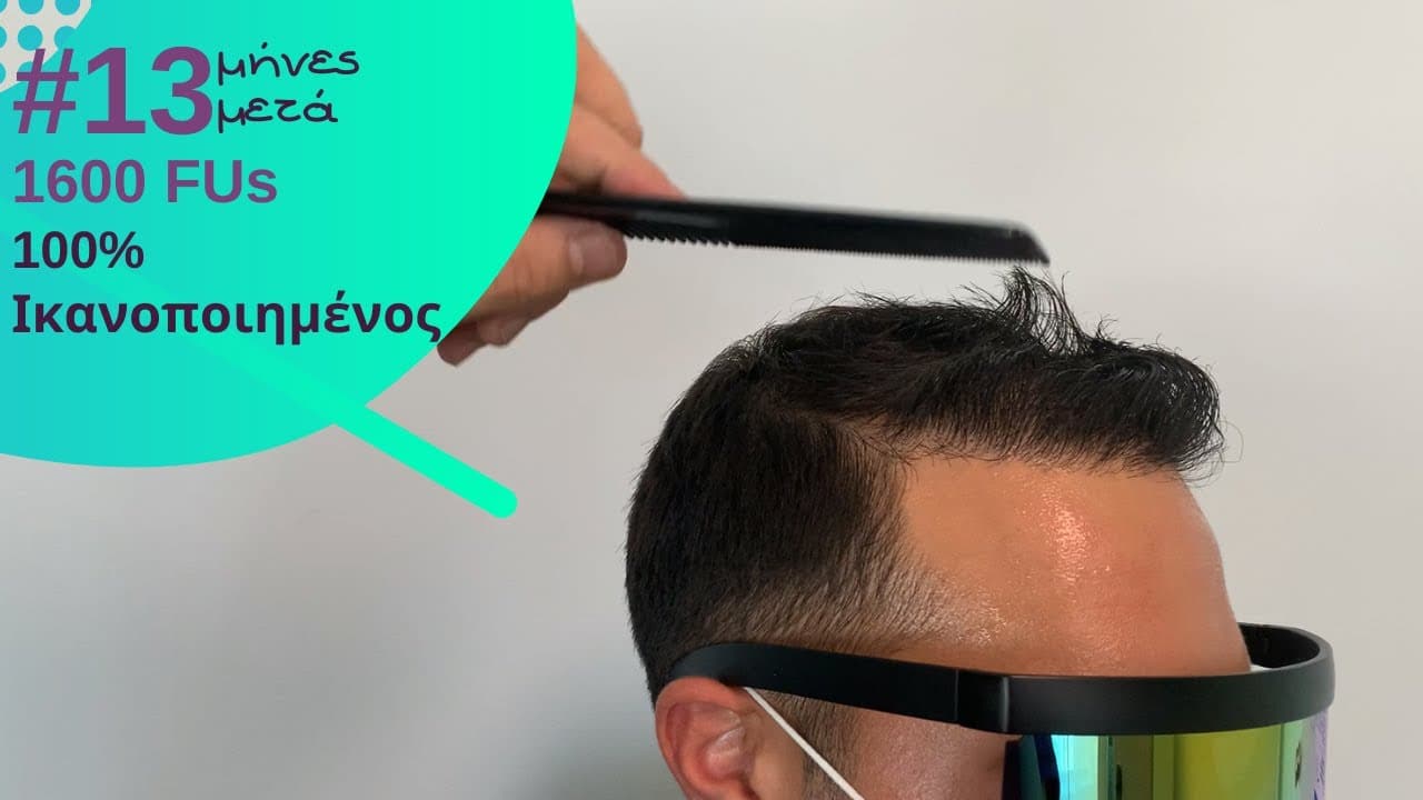 αποτελεσμα anastasakis hair clinic σε video 13 μηνες μετα με 1600fus
