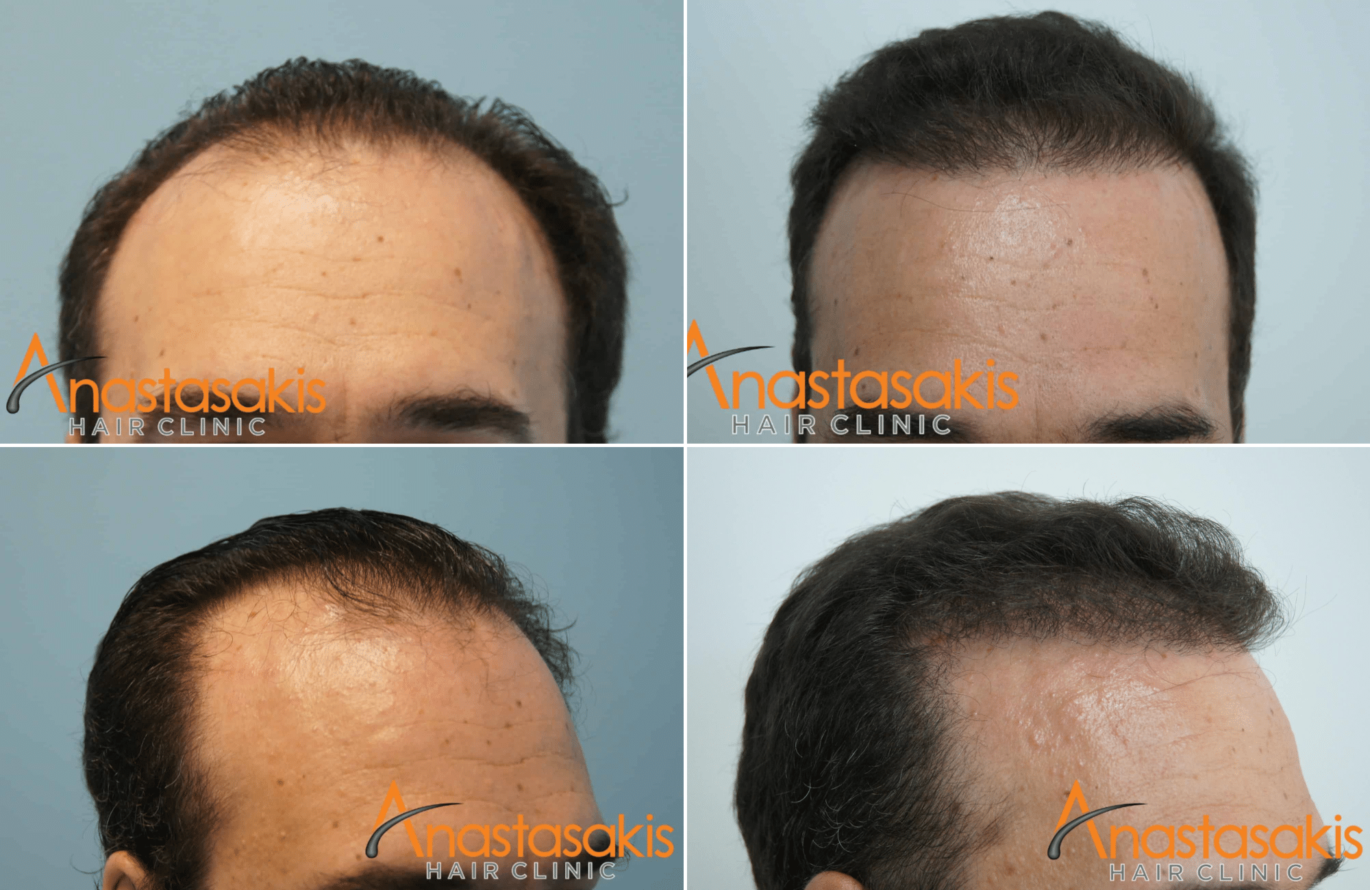 https://anastasakishairclinic.com/portfolio/3000fus-fut-mm-anastasakis-hair-clinic/