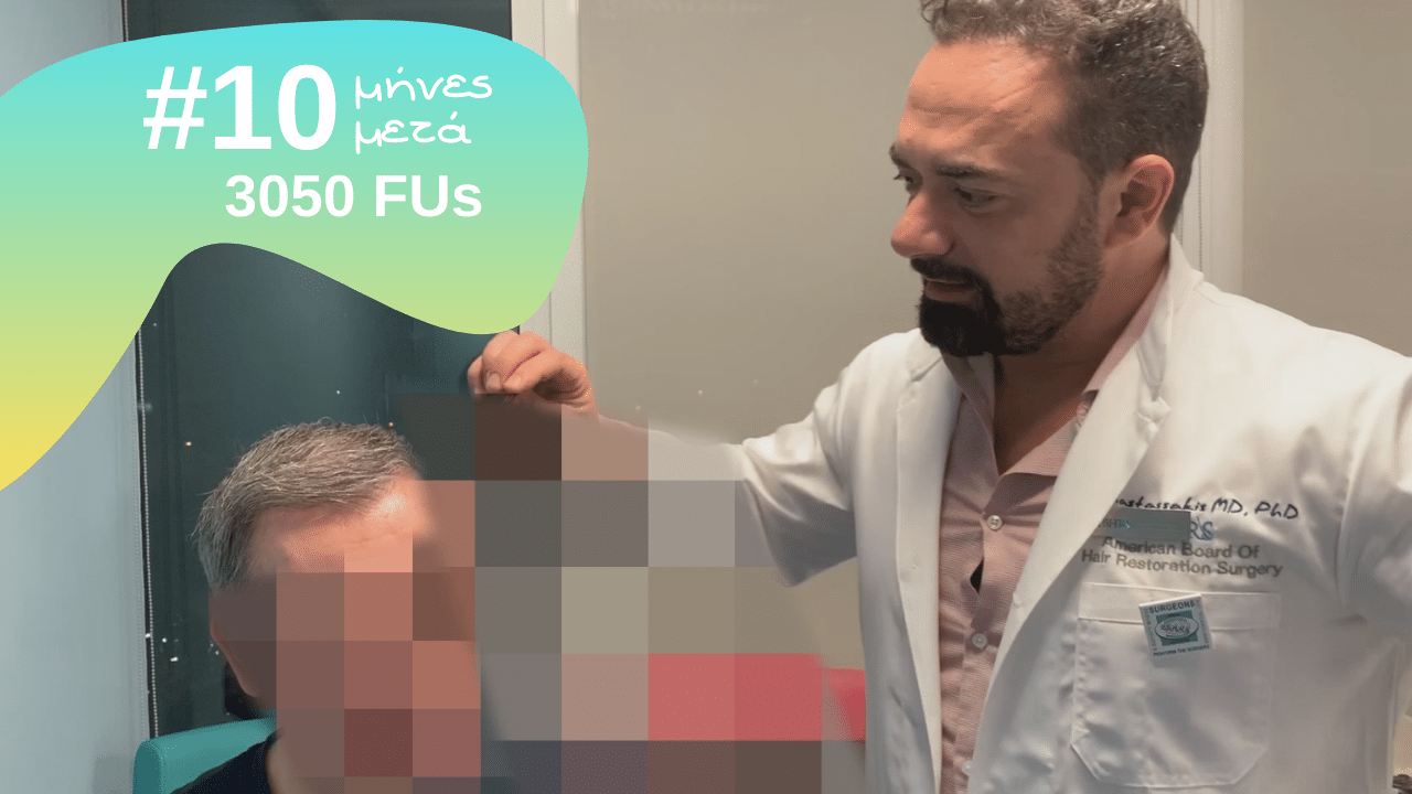 βιντεο εντυπωσιακα περιστατικα anastasakis hair clinic 10 μήνες μετα και 3050 τριχοθυλακια
