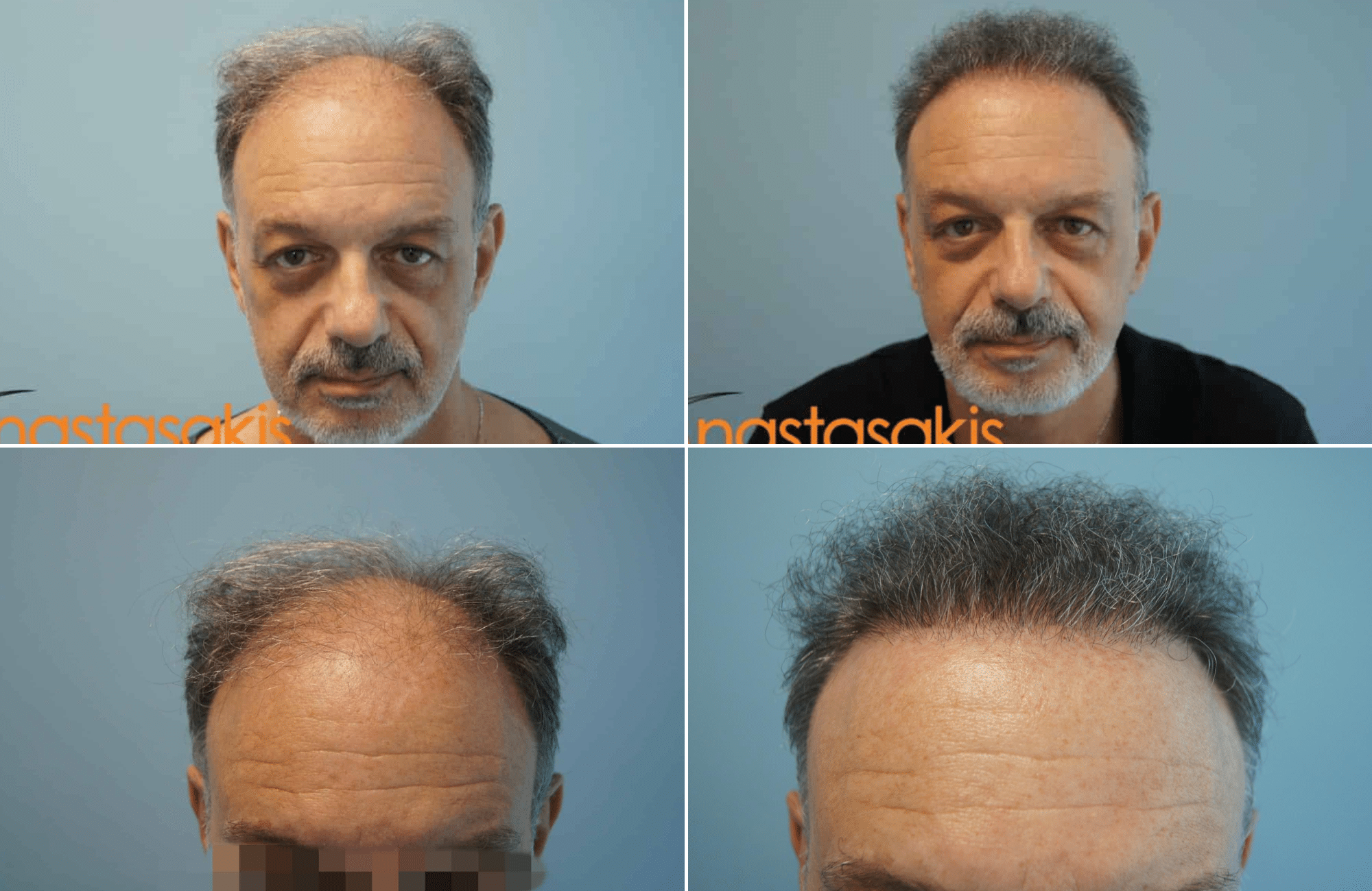 https://anastasakishairclinic.com/portfolio/apotelesma-metamosxefsis-malllion-2700fus-fut/