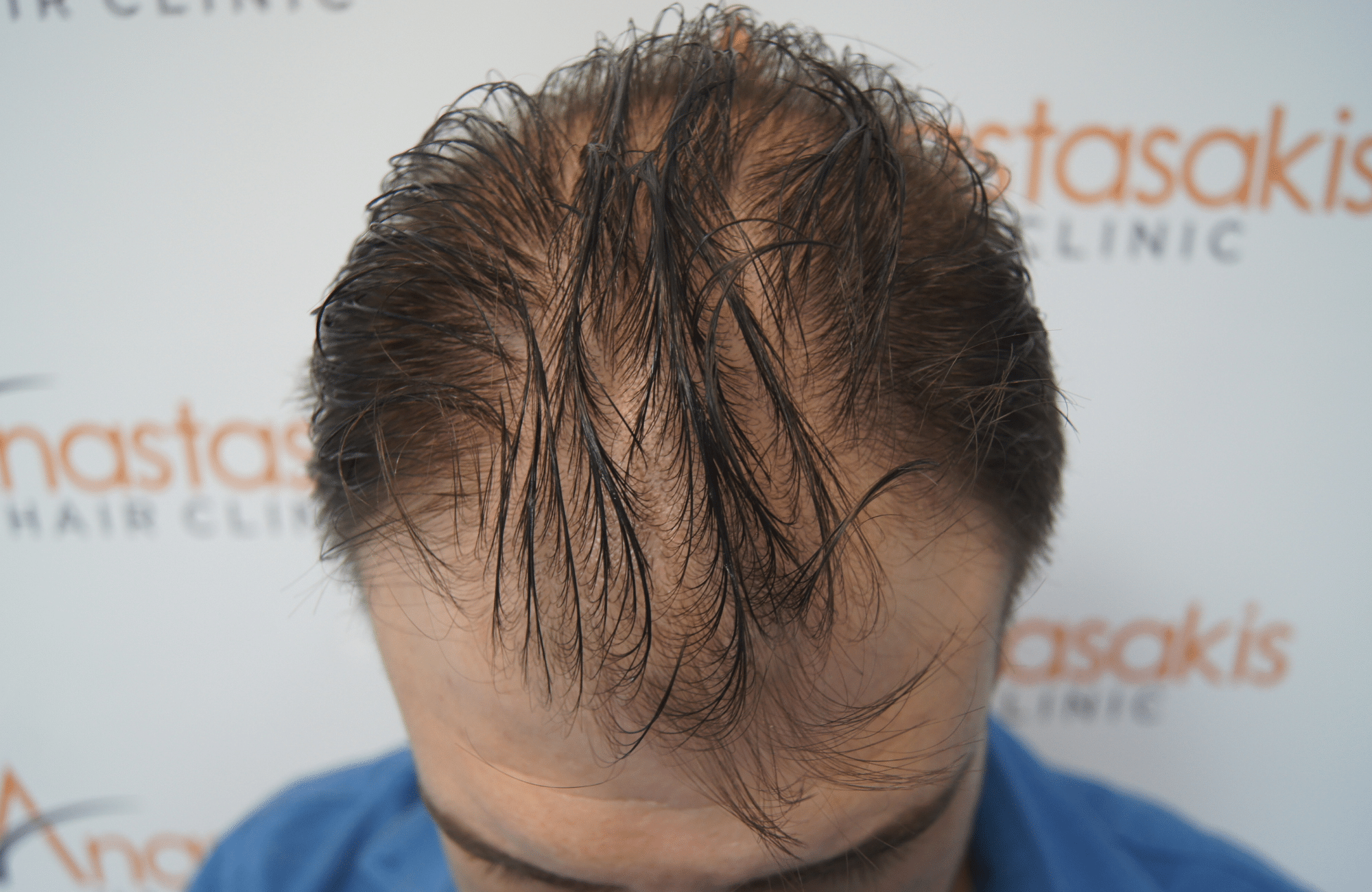 hair transplant result with 2600 follicular units anastasakis hair clinic