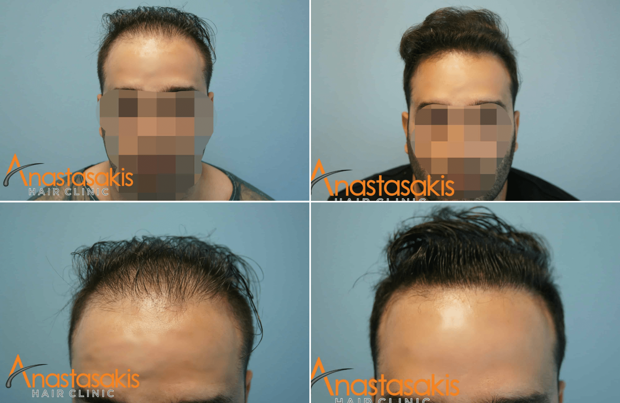 https://anastasakishairclinic.com/portfolio/combo-fue-fut-2080-fus-anastasakis-hair-clinic-result/