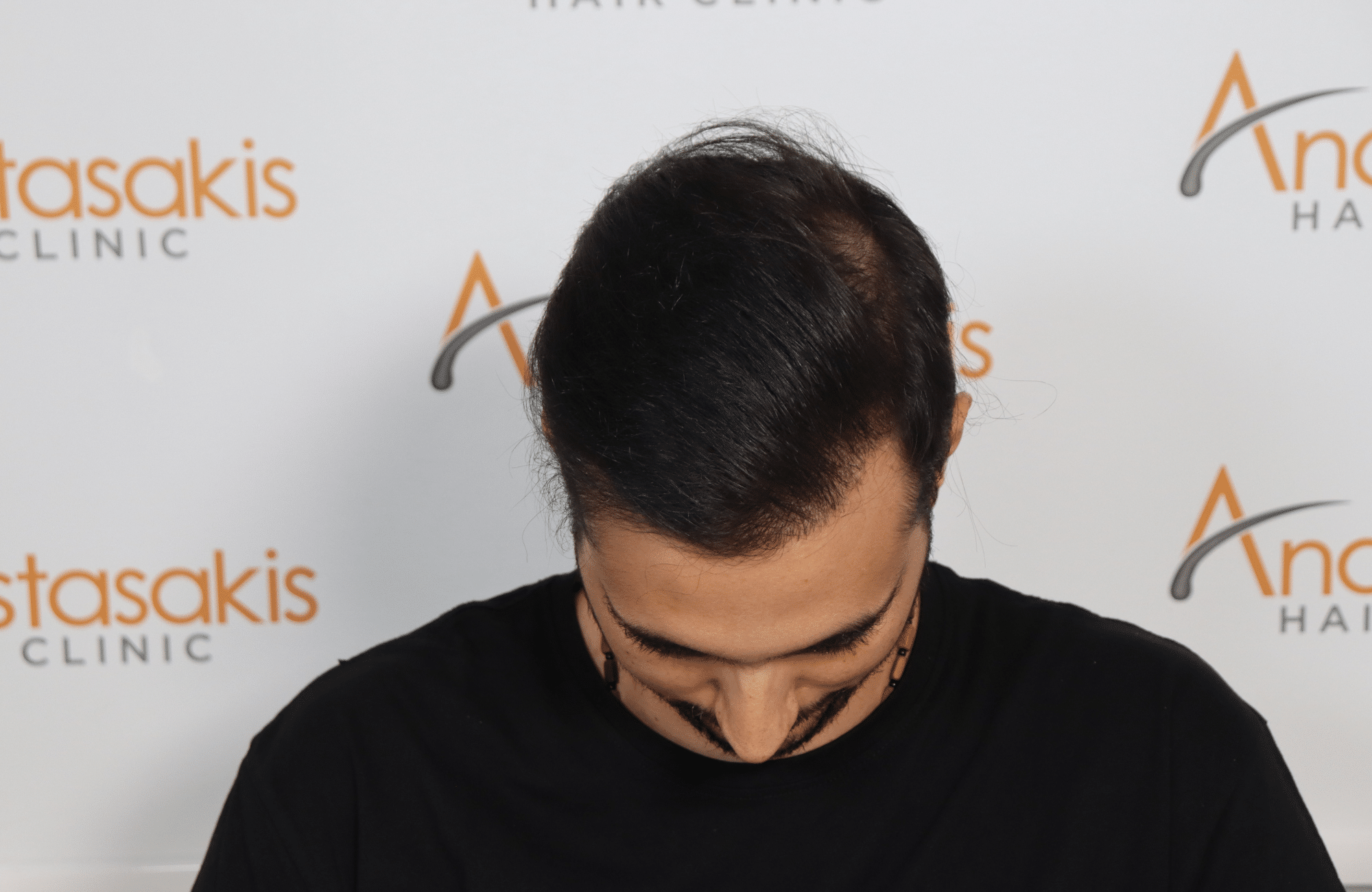 hair transplant result