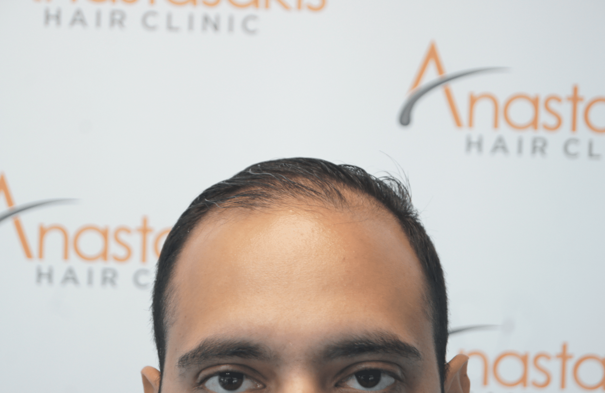 hair transplant result